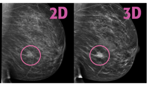 3D vs 2D mammography for detecting cancer in dense breasts