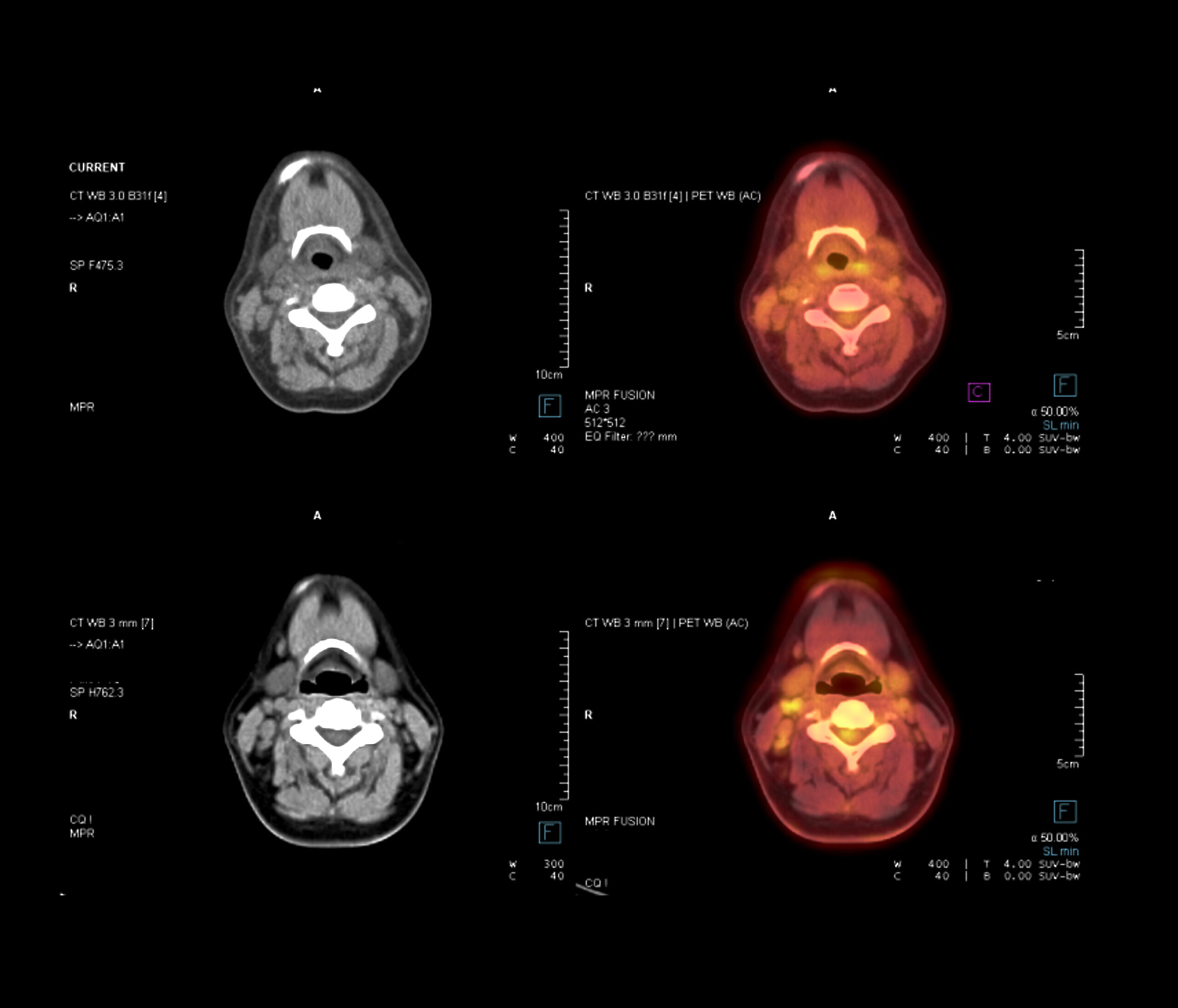 Pet Ct Scan Image Of Neck In Axial Plane Comparison Ct Scan And