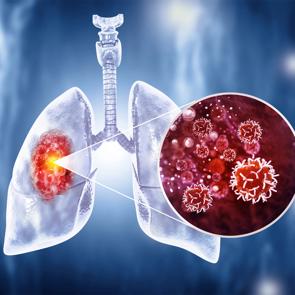 ct lung screening